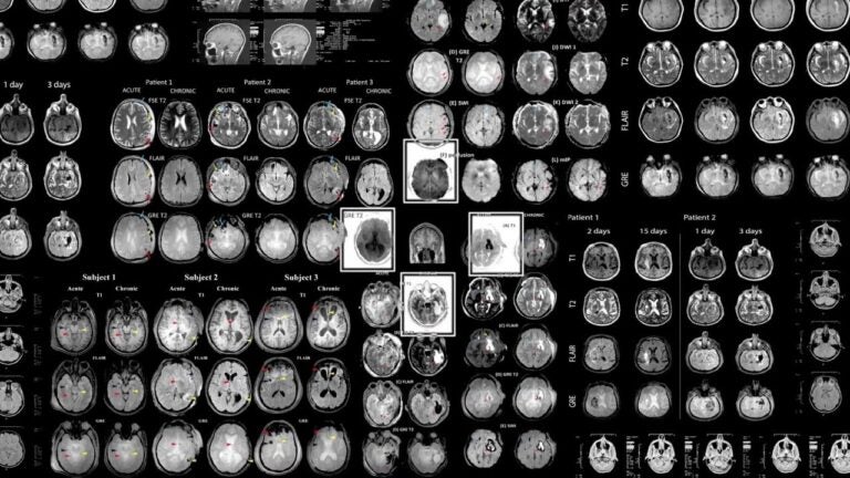 Brain scan x-rays from GAINN.